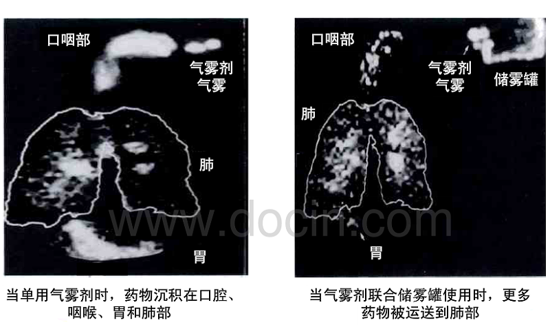 气雾剂结合气雾罐使用时治疗效果更佳